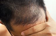 تطوير لاصق طبي يتحلل في الجسم يمكن استخدامه في زراعة الشعر...