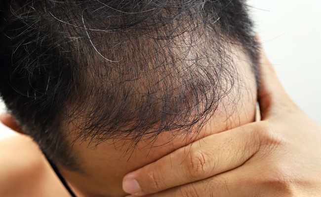 تطوير لاصق طبي يتحلل في الجسم يمكن استخدامه في زراعة الشعر...
