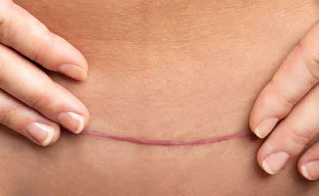 كيف تعرفين ان جرح العملية القيصرية ملتهب؟ وكيف يمكن علاجه؟
