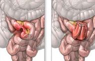 كيف يتمّ علاج شلل الأمعاء؟