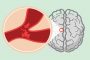 ابتكار قناع من مادة 