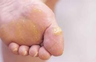 تنبّهوا الى أعراض الاصابة بعين السمكة ولا تهملوا هذه الحالة!