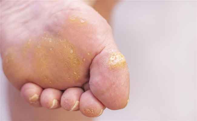 تنبّهوا الى أعراض الاصابة بعين السمكة ولا تهملوا هذه الحالة!