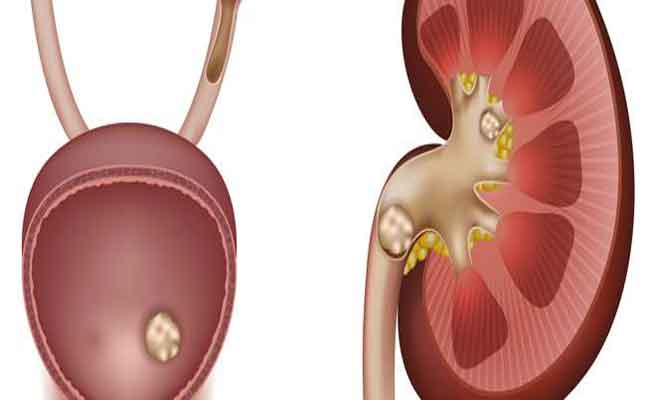 إليكم 5 علاجات منزلية للتخلّص من حصوات الكلى...