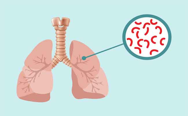 أسباب انتشار مرض السل في يومه العالمي 24...الأعراض والعلاجات