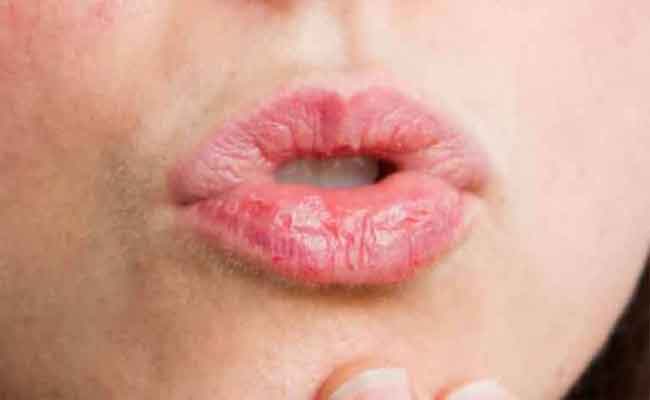 علاج فطريات الشفايف في المنزل بفعالية...والطرق الوقائية