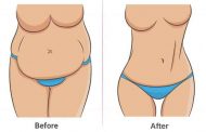 التجميل ما بعد الأمومة The Mommy Makeover...
