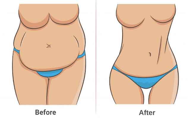 التجميل ما بعد الأمومة The Mommy Makeover...