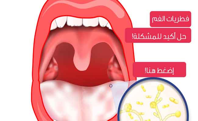 فطريات اللسان...ما أسبابها؟