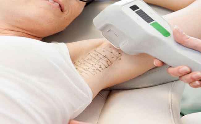 علاج التعرق الزائد تحت الإبط بخطوات بسيطة وفق طبيب متخصص