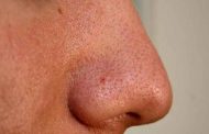 المسامات الواسعة وطرق علاجها Pore Minimizing...