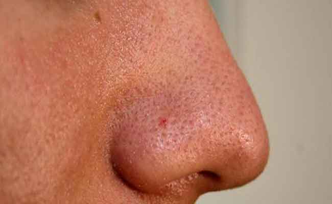 المسامات الواسعة وطرق علاجها Pore Minimizing...