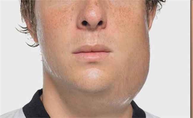 علاج النكاف للكبار هل هو متاح؟...وإليك بعض الحلول المنزلية