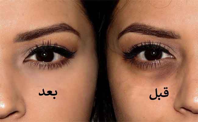 طرق علاج الهالات السوداء تحت العين في أسبوع...