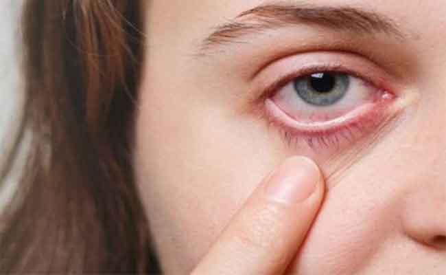 أعراض وأسباب حساسية العين خلال الصيف...الوقاية والعلاجات