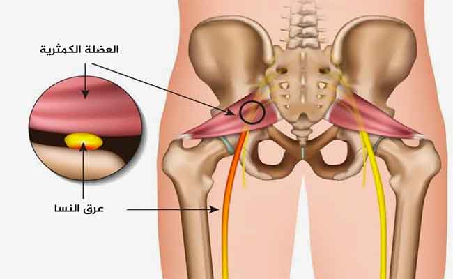 كلّ ما يجب أن تعرفوه عن أعراض عرق النسا وعلاجه...