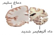 الزهايمر: علامة في البراز يمكن أن تساعد في التشخيص قبل ظهور الأعراض...