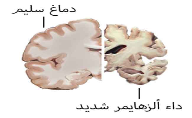 الزهايمر: علامة في البراز يمكن أن تساعد في التشخيص قبل ظهور الأعراض...