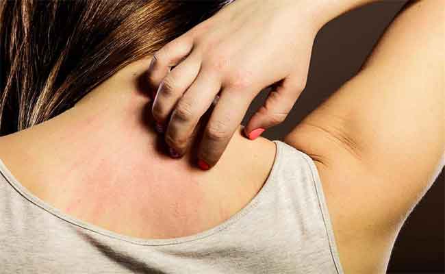علاج الحكة في الجسم بخطوات بسيطة...جرّبيها لراحة تامّة