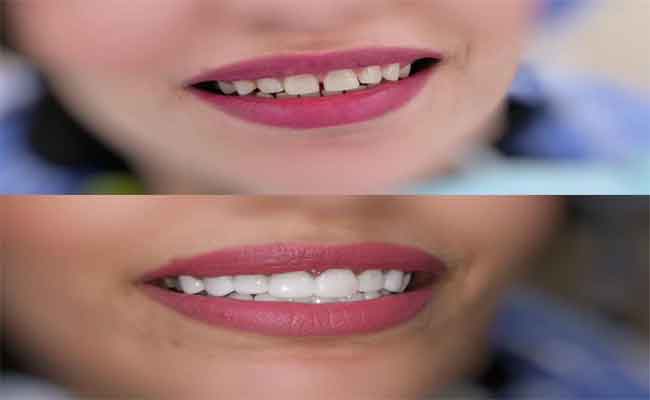 تقنية جديدة لابتسامة مشرقة في جلسة واحدة وفق طبيب تجميل...