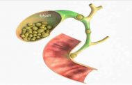 أعراض المرارة الصامتة لا يُمكن ملاحظتها...متى تستوجب العلاج؟