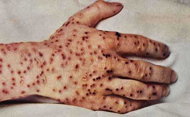 أعراض وعلاجات مرض الطاعون الدبلي...وطرق الوقاية بدقة