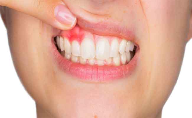 أسباب وأعراض خراج الأسنان أثناء الحمل وكيفية الوقاية