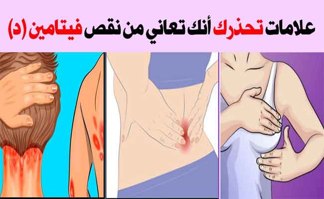 أعراض نقص الكالسيوم وفيتامين د عند النساء...خطيرة
