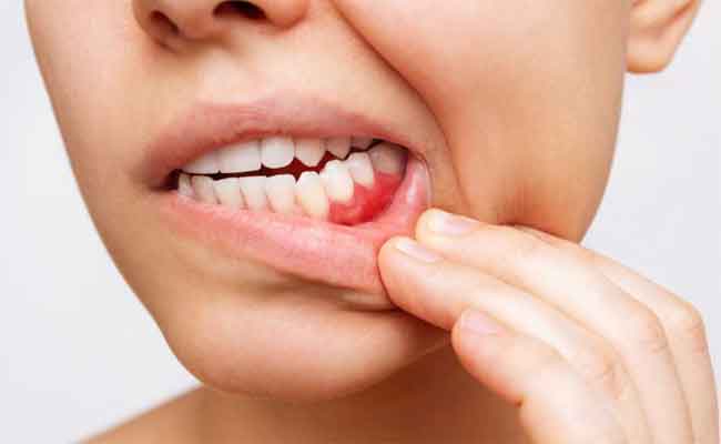 علاج التهاب اللثة وانتفاخها في المنزل...طرق سهلة وفعَّالة