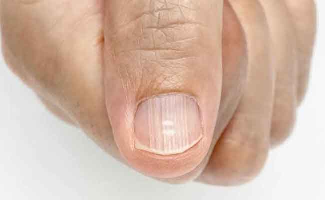 أسباب تعرج الأظافر بالطول وبالعرض تفصيلياً...والعلاجات المتاحة