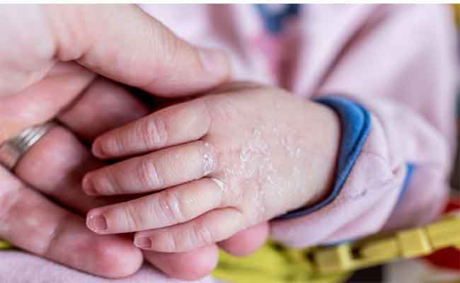 5 أمراض تسبب جفاف الجلد عند الرضع وإليكِ أبرز العلاجات...