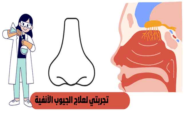 تجربتي مع عملية الجيوب الأنفية...جيدة وغير مؤلمة