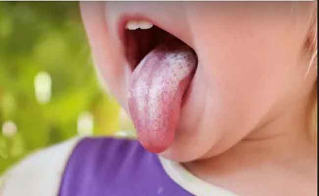 مضاعفات عدوى الخميرة عند الأطفال الرضع وطرق العلاج والوقاية...
