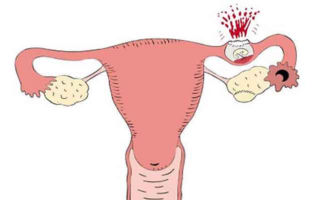 الحمل خارج الرحم...الأسباب والأعراض والعلاج