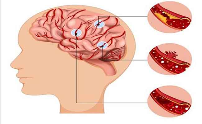 ما هي السكتة الدماغية؟...أنواعها وأعراضها والعلاجات