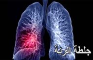 أعراض جلطة الرئة على مستوى عالٍ من الخطورة...