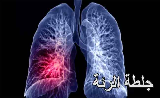 أعراض جلطة الرئة على مستوى عالٍ من الخطورة...