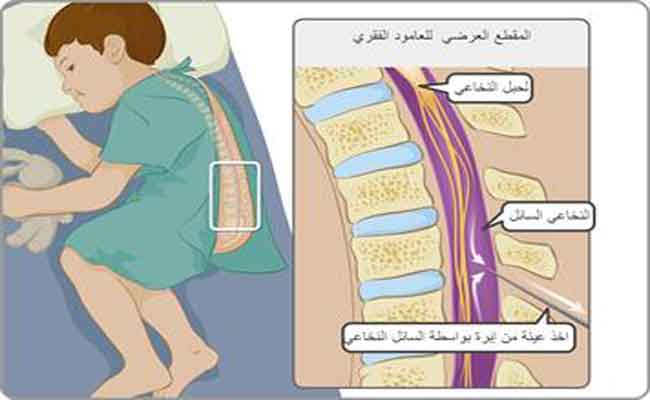 مرض السحايا للكبار...أعراضه وأسبابه وعلاجه