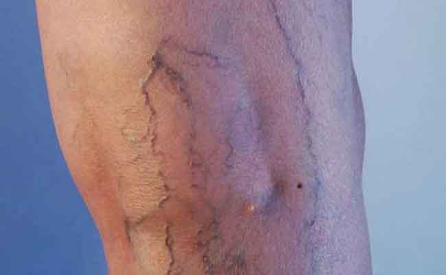 الدوالي عند النساء...في هذه الحالات تصبح خطيرة