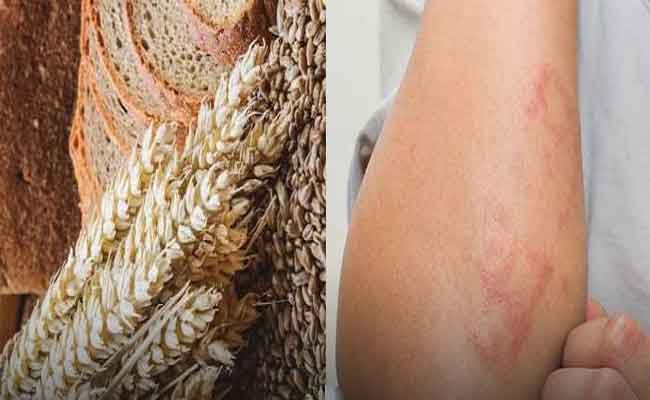 أعراض حساسية الجلوتين...الأسباب وطريقة العلاج وفق اختصاصية