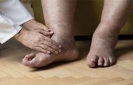 مريض السكري: طبيب الأقدام يحذر من هذه العلامة...