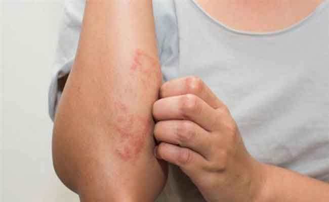 أسباب الإكزيما المفاجئة والأنواع والعلاجات المتاحة...