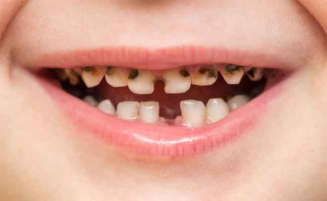 أبرز أسباب تسوس أسنان الأطفال وطرق الوقاية منه