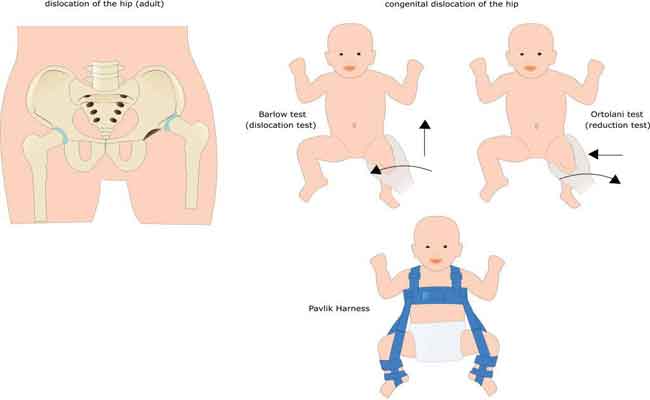 خلع الورك الخلقي لدى حديثي الولادة...أسبابه وطرق علاجه؟