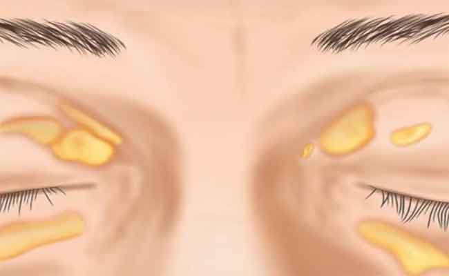 ما هي الزانثلازما وعلامات الإصابة بها والطرق العلاجية؟