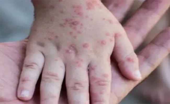 الجزائر لم تسجل أي حالة لجدري القردة وتعقد إجتماعا لمتابعة تطور الوباء