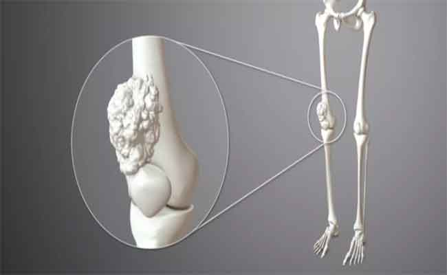 علامات وأعراض سرطان العظام...
