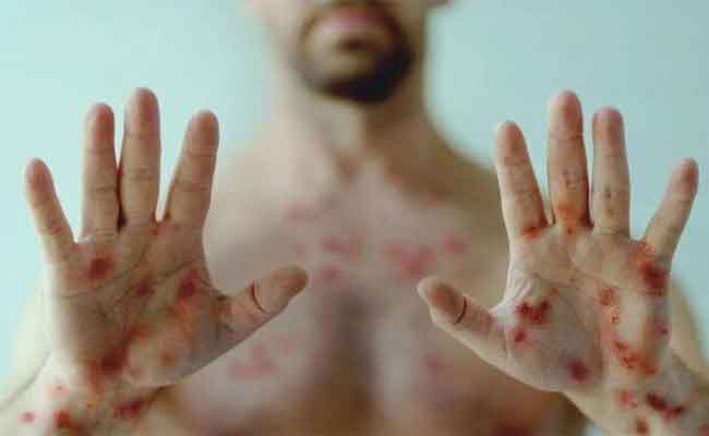 أهم 5 نصائح وإجراءات وقائية للحماية من جدري القردة...