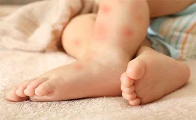 القوباء الفقاعية عند الأطفال أسبابها وطرق العناية بها