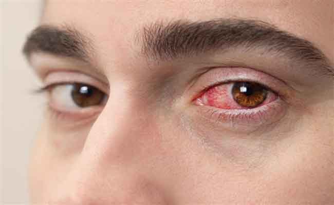 طرق فعالة لمحاربة إنتفاخ العينين في فصل الشتاء